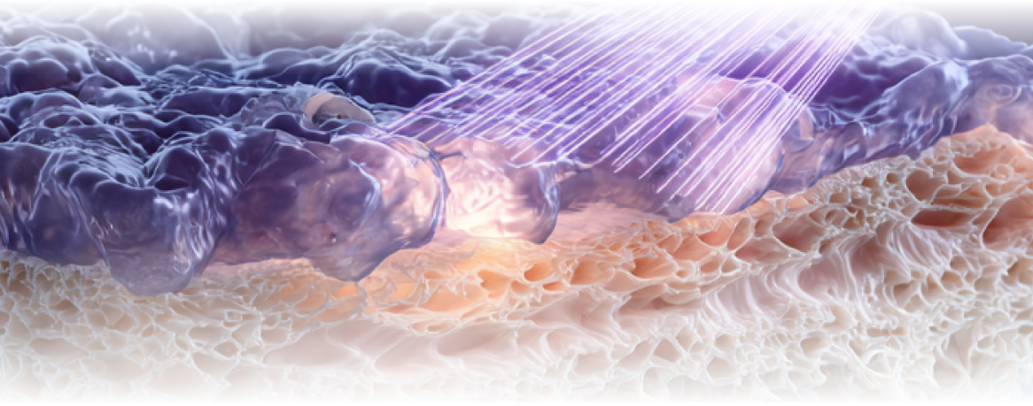 세 가지 파장을 동시에 사용하는 티타늄 리프팅 장비의 시술 콘셉트를 설명하는 이미지