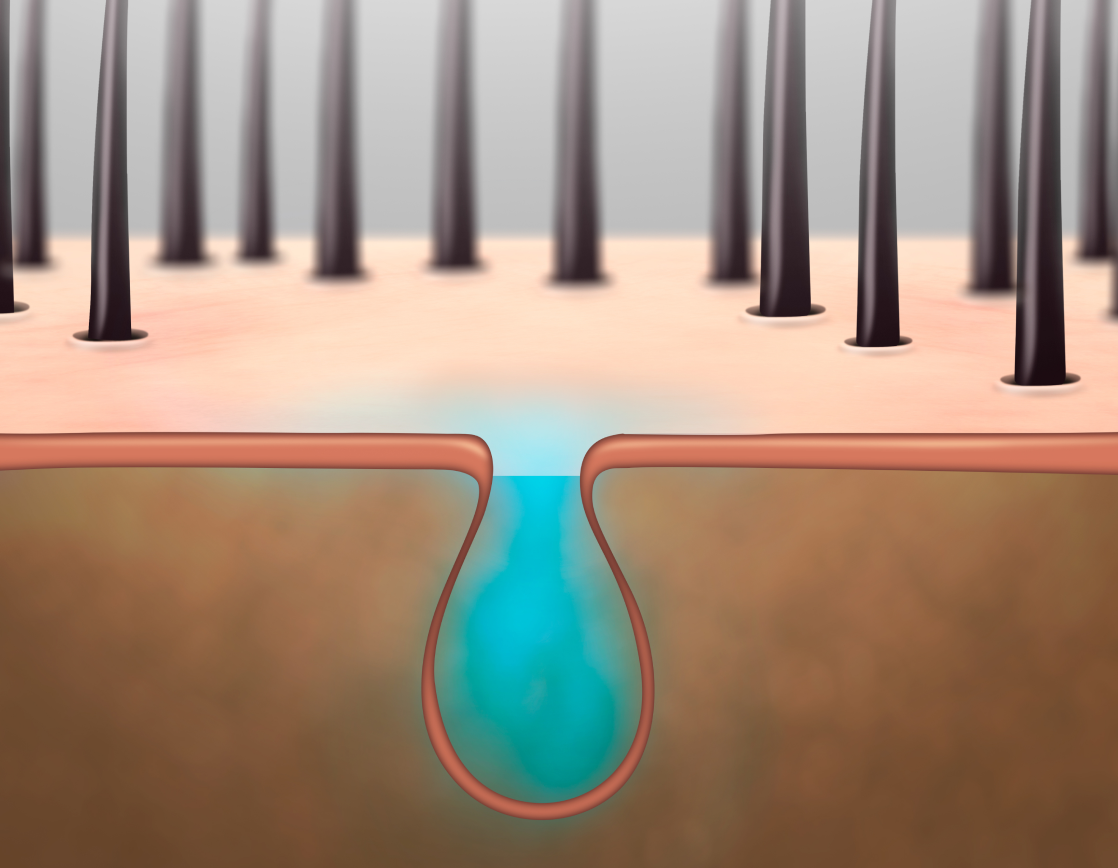 체모 감소와 재성장 억제 효과를 표현한 아포지 플러스 레이저 제모 효과 설명 이미지