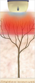 얕은 진피층을 자극해 잔주름과 모공을 개선하는 SHR 모드 작용 원리 이미지