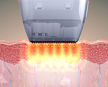 SFA,팁의 고주파 도달 깊이를 비교해 보여주는 비침습형 팁 안내 이미지