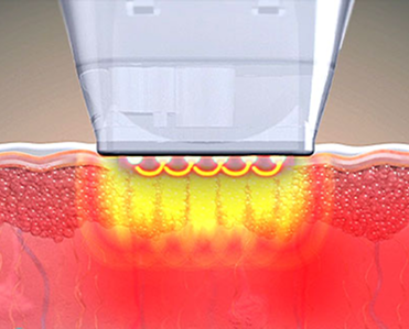 DDR팁의 고주파 도달 깊이를 비교해 보여주는 비침습형 팁 안내 이미지