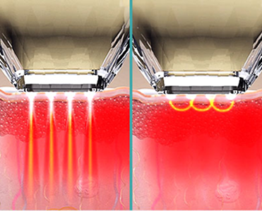 DIAMOND 팁의 고주파 도달 깊이를 비교해 보여주는 비침습형 팁 안내 이미지