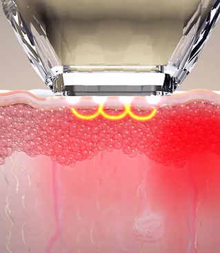 바이폴라 고주파가 조사되는 다이아몬드 팁 작용 원리 설명 이미지