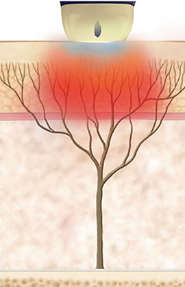 얕은 진피층을 자극해 잔주름과 모공을 개선하는 SHR 모드 작용 원리 이미지