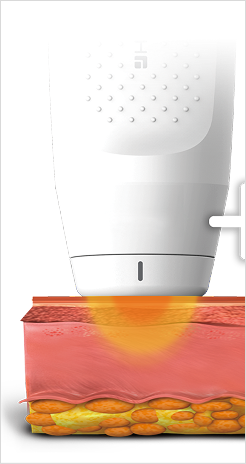 고주파 에너지가 진피층에 열을 전달해 콜라겐 생성을 유도하는 구조 설명 이미지