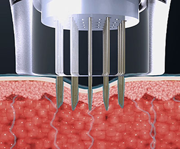 마이크로니들이 피부에 침투해 고주파 에너지를 전달하는 침습형 시술 단계 설명 이미지