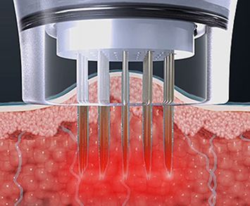 마이크로니들이 피부에 침투해 고주파 에너지를 전달하는 침습형 시술 단계 설명 이미지