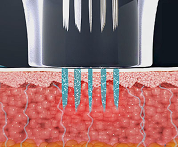 마이크로니들이 피부에 침투해 고주파 에너지를 전달하는 침습형 시술 단계 설명 이미지
