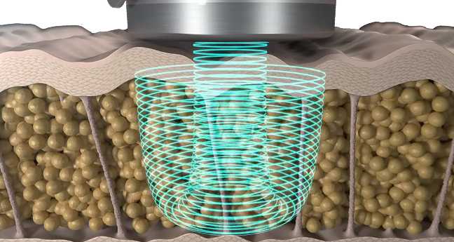 마이크로 극초단파 에너지가 지방층과 진피층에 선택적으로 흡수되어 지방세포를 분해하는 바디 온다 시술 원리를 설명하는 이미지