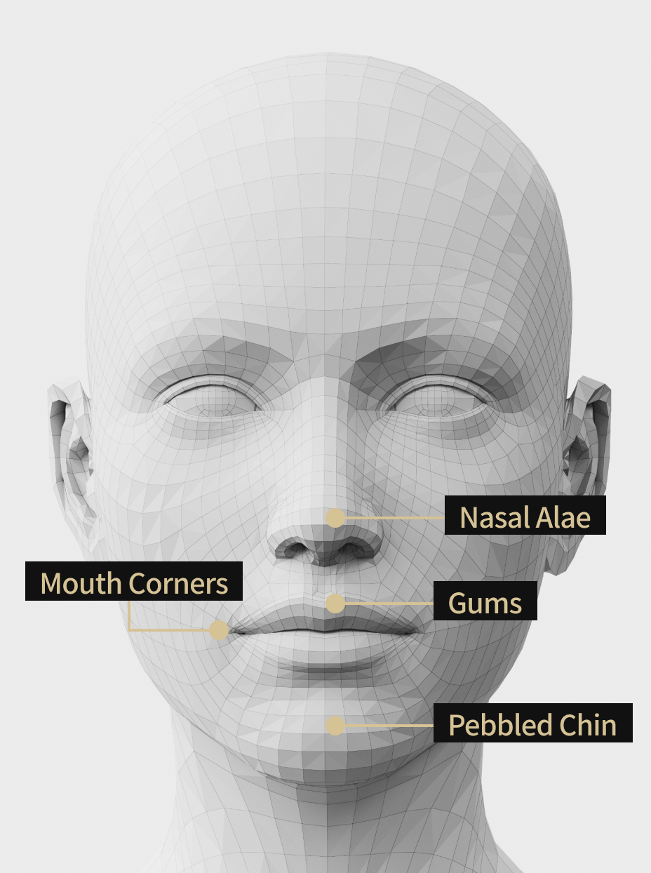 An explanatory image showing the areas where Botox is applied: the bridge of the nose, gums, chin, and corners of the mouth.