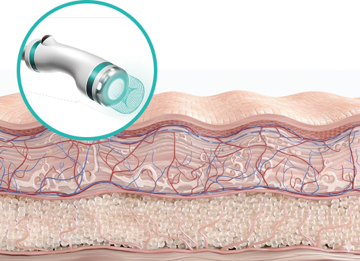 진피층을 자극해 탄력과 처짐 개선을 돕는 3mm 핸드피스 작용 원리 이미지