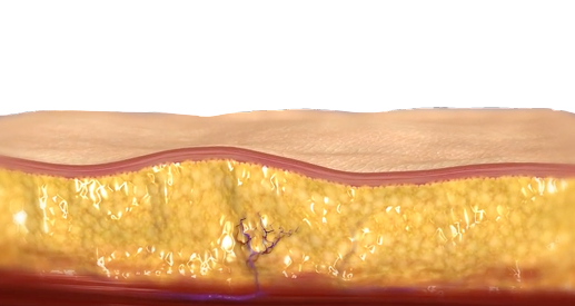 고주파, 전기 자극, 배큠 흡입이 동시에 작용하는 바디 인모드 삼중 에너지 구조 설명 이미지 (시술전)