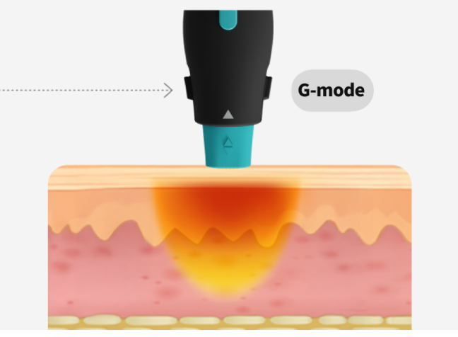 A graphic image visualizing the principle of the OligioX treatment, in which 6.78MHz high-frequency energy delivers heat to the dermis layer.