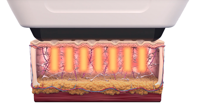 7개의 열기둥이 초음파 빔을 진피 1.5mm 깊이에 전달하는 소프웨이브 기술 이미지