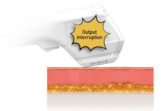 고주파와 초음파를 한번에! 브이로 리프팅
